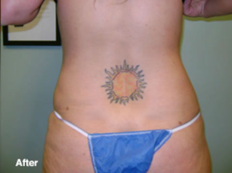 SmartLipo_after Larchmont